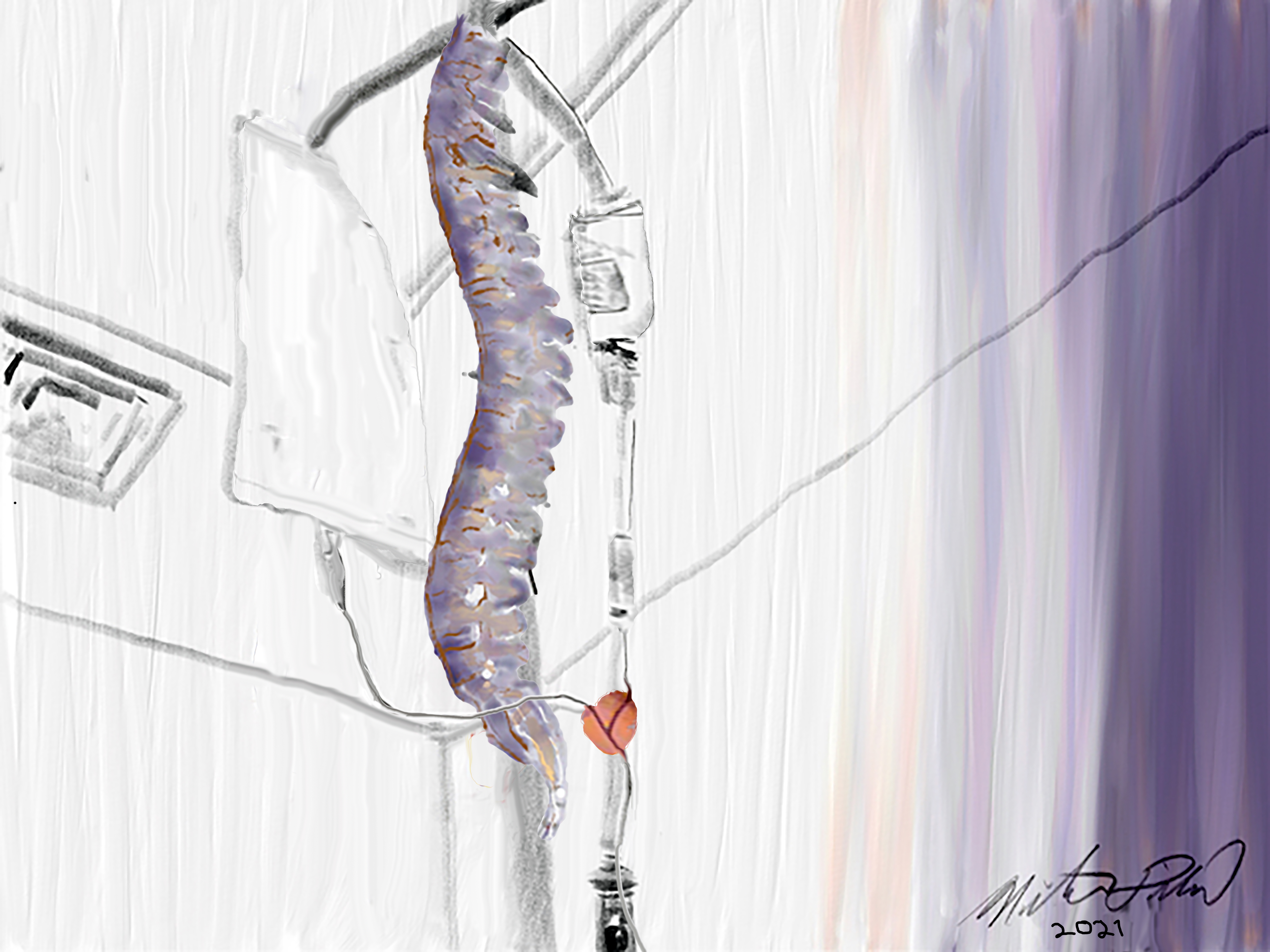 lymphoma-prostate- MD30